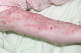 Figure 6. Linear papules and pustules of incontinentia pigmenti stage 1