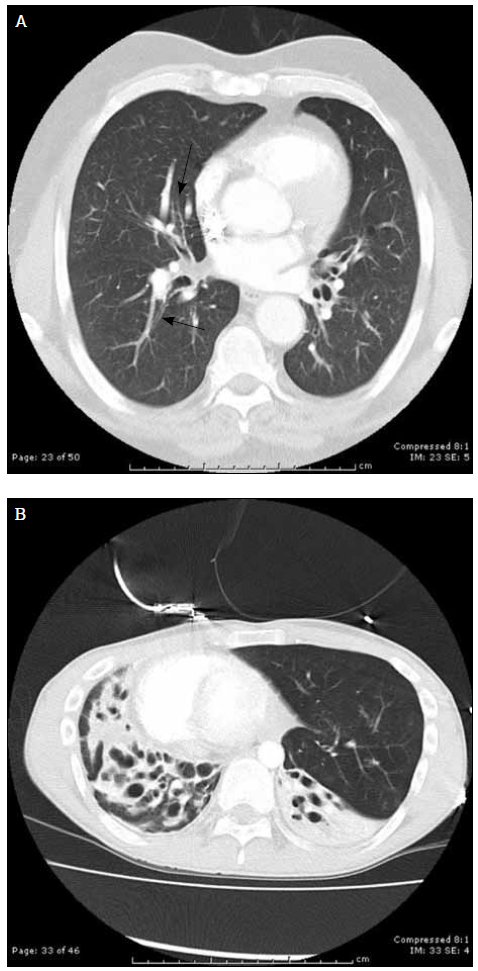 Figure 1. Changes of bronchiectasis on c-HRCT can be subtle. A) Dilatation and loss of normal tapering of right middle lobe bronchi (arrows) or obvious; B) Bilateral saccular dilatation of bronchi with associated collapse and parenchymal destruction