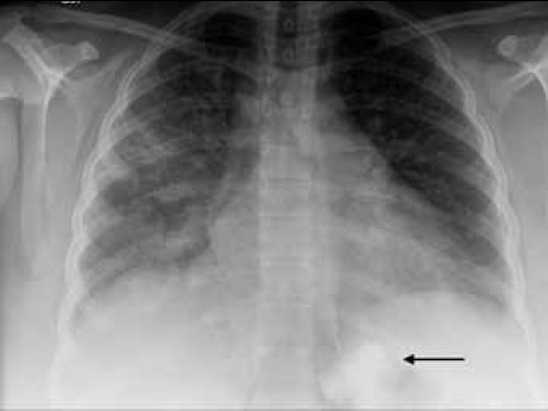Figure 1. Chest X-ray of Case 1 showing bilateral lower zone increased air space opacities. Note the correct position of the LAGB inferior to the diaphragm (arrow)