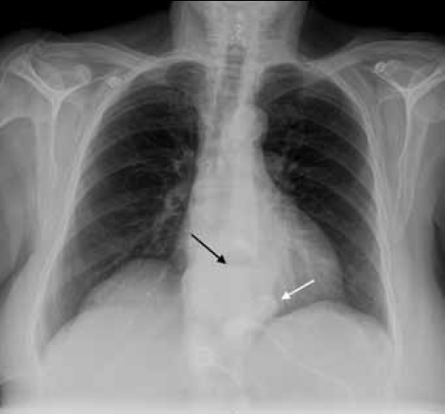 Figure 2. Chest X-ray of Case 2 showing an air fluid level in the mediastinum (black arrow) consistent with oesophageal dilatation. Note that the LAGB is visible above the level of diaphragm (white arrow), suggestive of slippage into the inferior mediastinum. This is confirmed on Figure 3