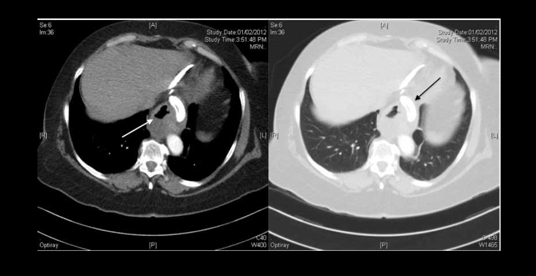 Figure 3. CT scan of Case 2 confirming clear lung fields and dilated oesophagus (white arrow). The LAGB has slipped into the inferior mediastinum (black arrow)