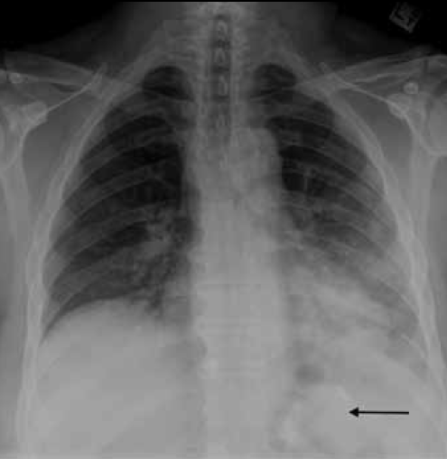 Figure 4. Chest X-ray of Case 3 showing left lower zone air space opacity. Note the correct position of the LAGB inferior to the diaphragm (arrow)