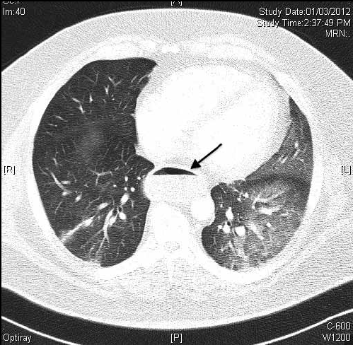 Figure 5. CT scan of Case 3 showing bilateral air space opacities and oesophageal dilatation with air fluid level (arrow)