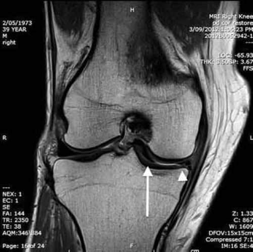 Figure 1. MRI of the patient's right knee