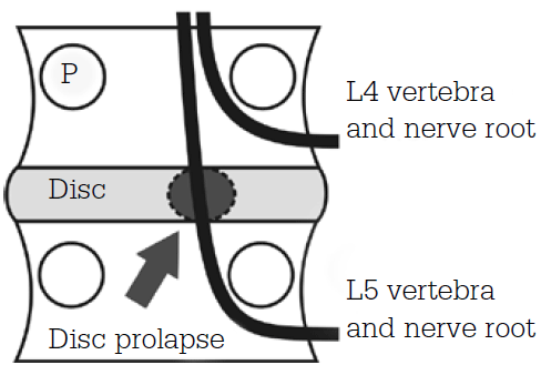 Figure 1. The relationship of the exiting nerve roots, pedicle (P) and intervertebral disc