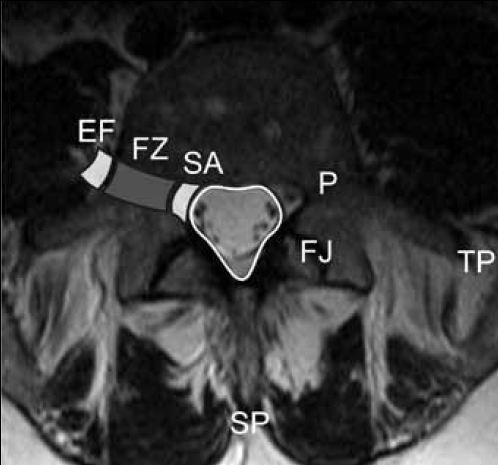 Figure 2. Axial T2-weighted slice of the lumbar spine demonstrating the various zones along the course of the exiting nerve roots from the sub-articular zone (SA) to the foraminal zone (FZ) and the extra-foraminal zone (EF)