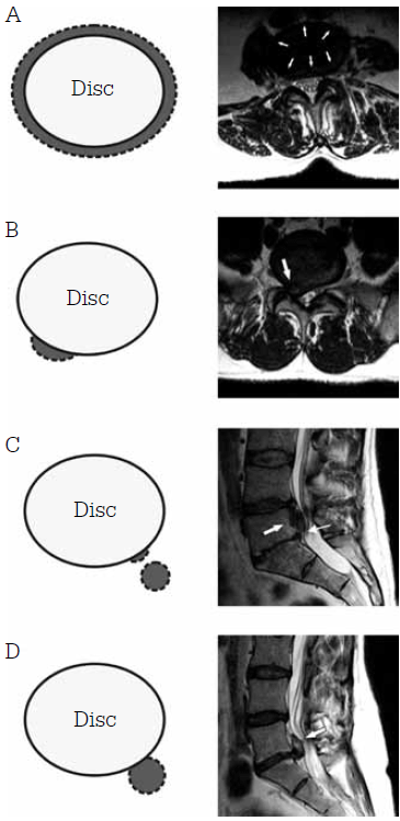 Figure 3. Axial illustration and T2- weighted MRI of the lumbar spine showing disc herniation