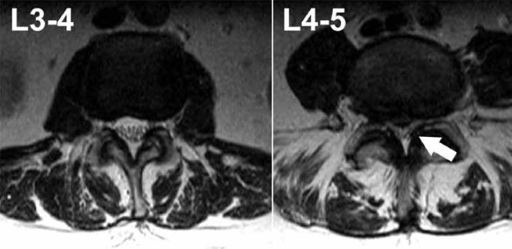 Figure 4. T2-weighted axial slices of the lumbar spine of the same patient at different levels.