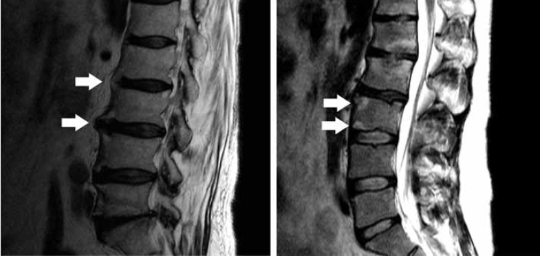 Figure 5. Sagittal T2-weighted images of the lumbar spine in two separate patients with ankylosing spondylitis.