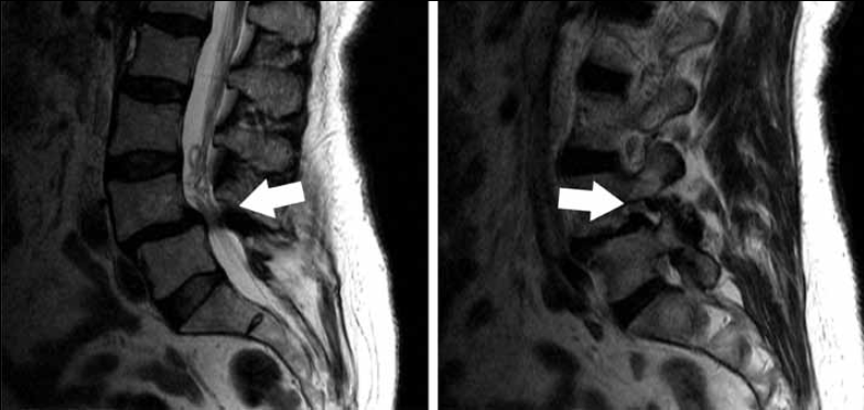Figure 6. Sagittal T2-weighted MRI acquisitions of the lumbar spine.