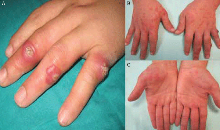 Figure 1. Finger nodules on presentation A) and 1 week later B) and C)