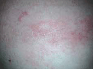 Figure 2. Close-up view of the patient’s rash