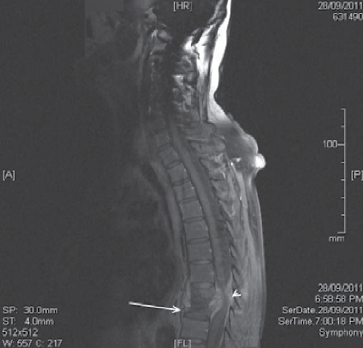 Figure 1. A sagittal section T1 weighted
MRI showing pathological fracture of T8
and T9 vertebra (arrow) with spinal cord
compression (arrowhead)