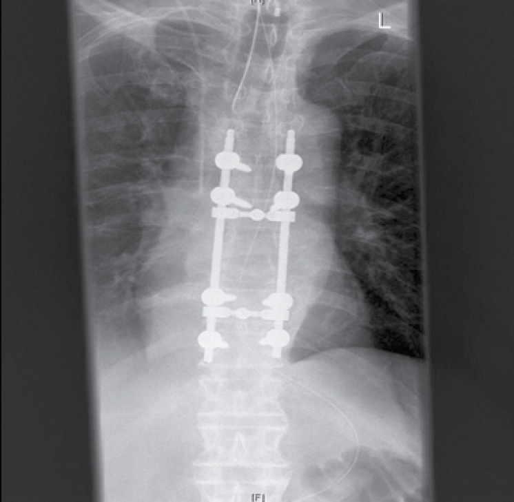 Figure 2. Plain AP X-ray after surgical
decompression and pedicle fusion