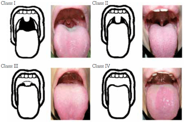 Figure 1. Mallampati classification of upper airway
Adapted from Huang H, et al. BMC Gastroenterology 2011, 11:12 doi:10.1186/1471-
230X-11-12, under the terms of the creative commons attribution license