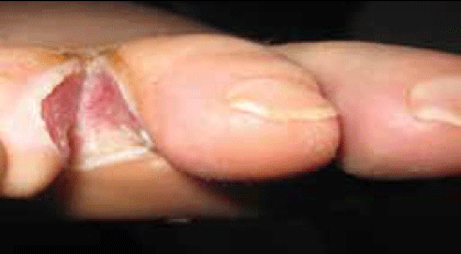 Figure 1. Third interdigital space of right foot
with an erosive and exudative lesion on an
erythematous background. Edges are white,
due to maceration