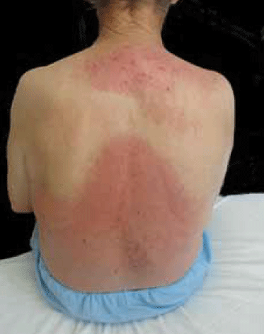 Figure  3. Rash seen on the patient's back