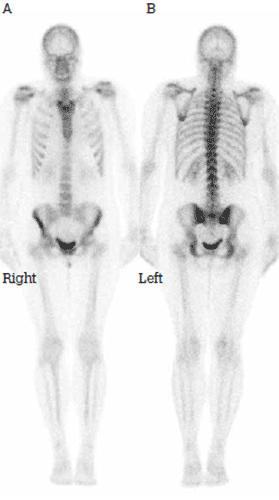 Figure 1. Normal bone scan in standard
projections: A) anterior and B) posterior
