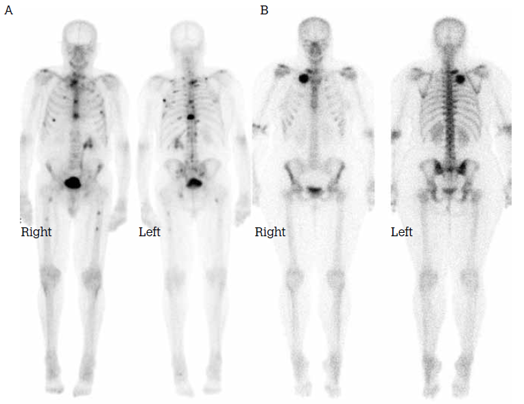 Figure 2. A) Multiple skeletal metastases; B) Fibrous dysplasia of the right first rib