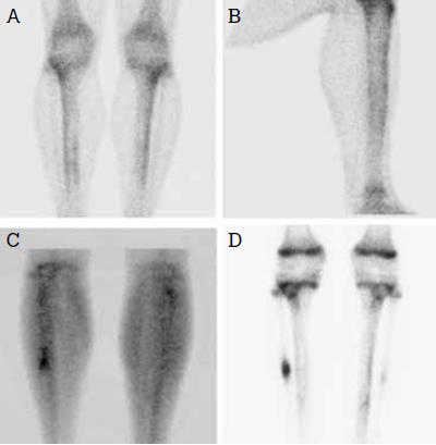 Figure 3. 'Shin splints' in (A) anteroposterior
and (B) lateral views. Acute right fibular
stress fracture in (C) blood pool phase
and (D) delayed phase (with linear uptake
at the physes indicating normal active
growth plates in this adolescent); the faint
abnormality in the left fibula in (D) is due to
an older, healing stress fracture