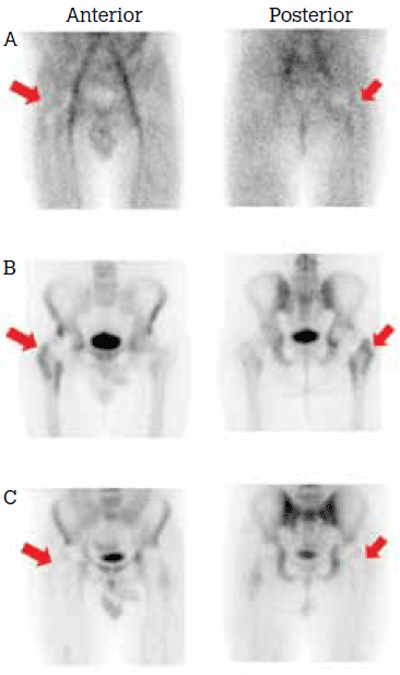 Figure 5. Increased activity associated
with the hip prosthesis in (A) blood pool
and (B) delayed phases. The X-rays were
normal; C) Absent white cell activity
excluded infection