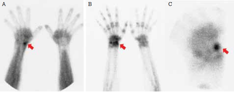 Figure 6. Scaphoid fracture with corresponding intense localised blood pool (A) and
delayed phase activity (B). Magnified (pinhole) delayed image (C)
