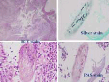 Figure 2. Histology from punch biopsy