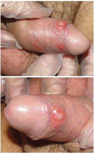 Figure 1a, b. Multiple ulcers on the
patient's penis