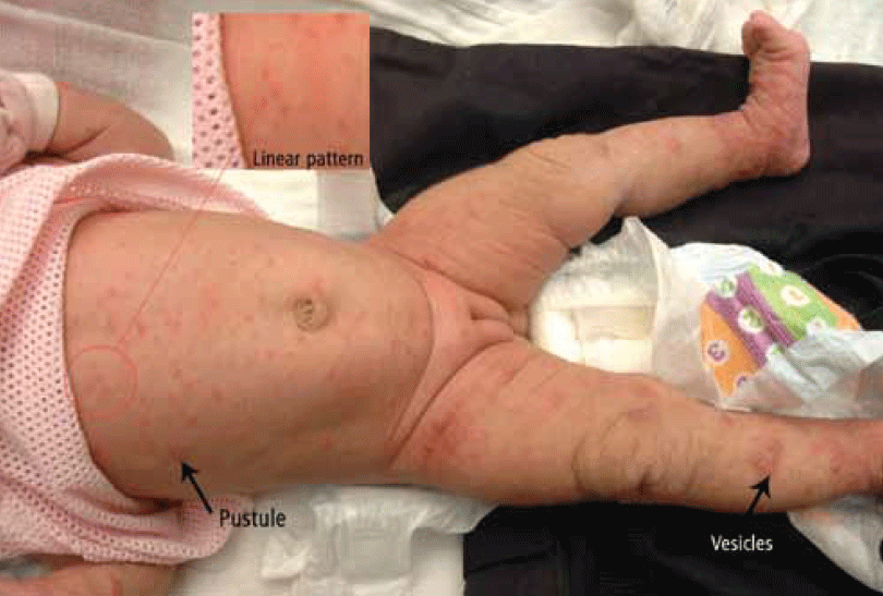 Figure 1. Papules, vesicles, pustules and linear pattern of burrows on the infant’s body
