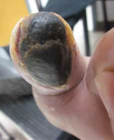 Figure 1. The patient’s  toe at presentation