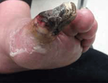 Figure 3. The patient’s  toe at 4 weeks