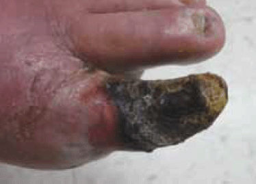 Figure 4. The patient’s  toe at 5 weeks