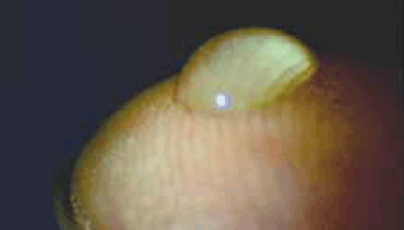 Figure 1. Eye drop applied to the fingertip, illustrating the holding of its shape