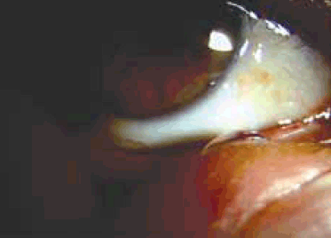 Figure 2. Eye drop being transferred to the medial canthus of the eye without loss of the eye drop or spillage