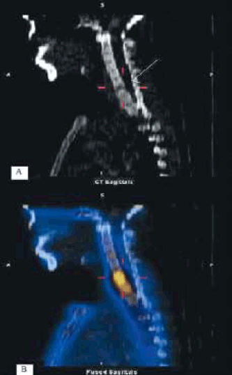 Figure 4. A) Erosive lesion of C7 body invading superior endplate and C6–7 disc (arrow) on CT sagittal slice