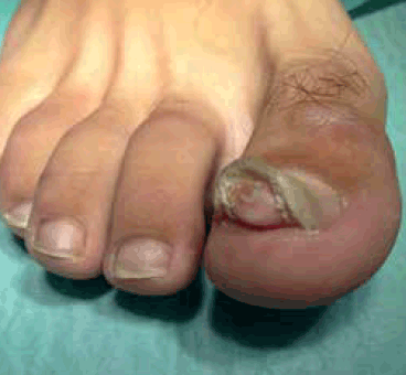 Figure 1. Clinical appearance of the lesion located on the patient’s right great toe