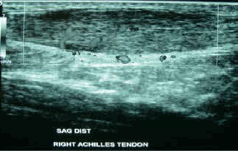 Figure 1. Doppler ultrasound showing the classic features of non-insertional Achilles tendinopathy with fusiform thickening, hypoechoic regions and neovascularisation
