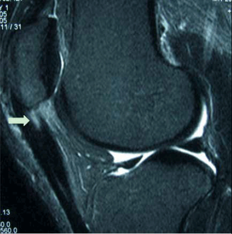 Figure 2. MRI showing deep proximal patellar tendon degeneration with underlying fat pad inflammation