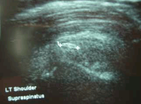 Figure 6. Ultrasound showing calcific supraspinatus tendinopathy.
