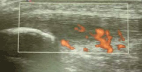 Figure 7. Doppler ultrasound of patellar tendinopathy showing the neovessels.