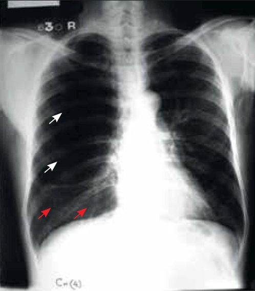 Figure 1. Chest X-ray (PA view) of
the patient taken following acute
breathlessness and chest pain
