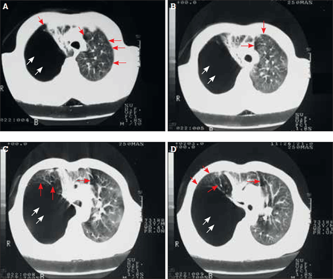 Figures 2a to 2d. High resolution computed tomography chest scan