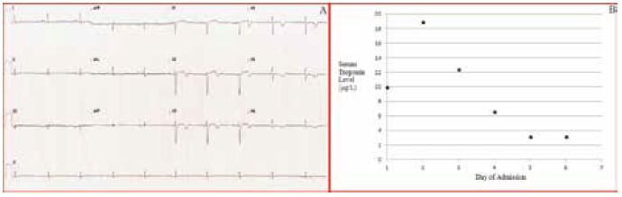 Figure 1. Case study 1: ECG demonstrated T wave inversion in leads V2 to V6