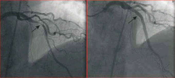 Figure 2. Case study 1: coronary angiogram in right anterior oblique cranial projection demonstrated the severe proximal LAD lesion