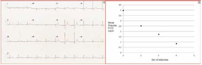 Figure 3. Case study 2: ECG demonstrated minor ST-segment elevation in leads II, III, aVF