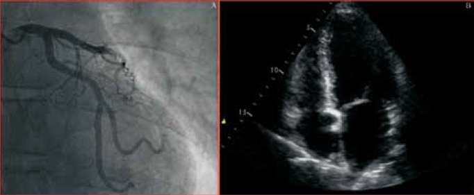 Figure 4. Case study 2: coronary angiogram in left anterior oblique cranial projection demonstrated smooth coronary arteries