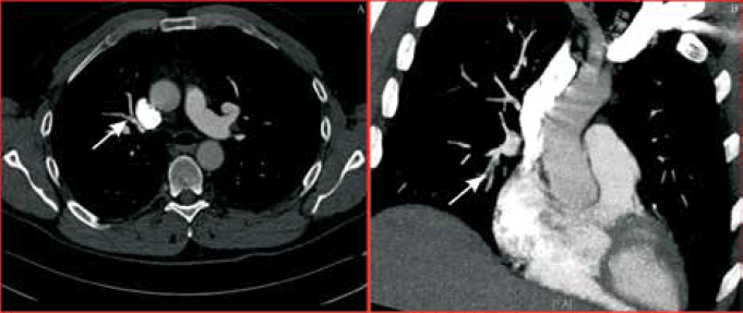 Figure 5. Case study 2: Computed tomography pulmonary angiogram demonstrated right middle lobe pulmonary artery embolus