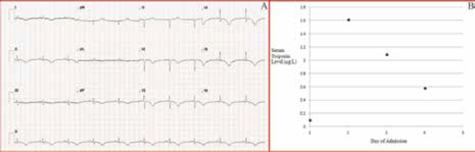 Figure 6. Case study 3: ECG demonstrated widespread T wave inversion in leads II, III, aVF, V2 to V6