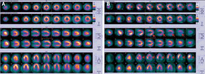 Figure 1. (a) Standard MPS display format. (b) Lateral wall has reduced radiotracer activity in the stress phase (arrows) and normal perfusion in the rest phase, indicating ischaemia