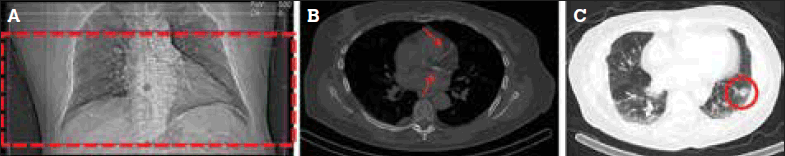 Figure 3. CT for AC has a limited field of view (box) (a) but may identify coronary calcification (arrows) (b) and pulmonary nodules (circle) (c)